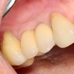 Через 1,5 года после протезирование. Восстановлены не только зубы, но и весь объем окружающих мягких тканей