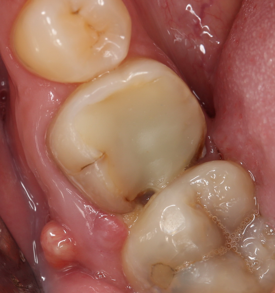 Гематома после удаления зуба