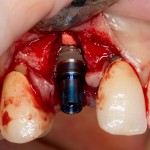 немедленная имплантация: сразу после удаления зуба НЕМЕДЛЕННО устанавливается имплантат