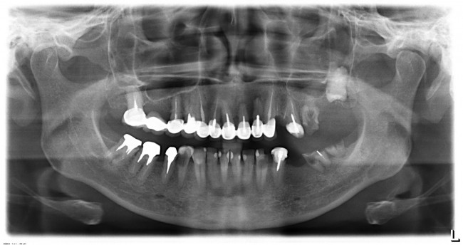 изначальная клиническая ситуация. Требуется имплантация во всех боковых участках зубного ряда