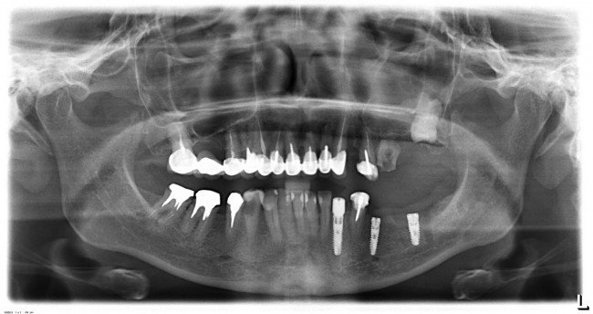 Первый этап лечения - установлены три импланта в левом нижнем сегменте зубного ряда.