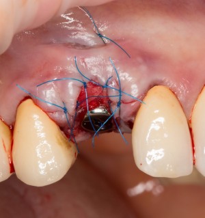немедленная имплантация: одновременно с установкой импланта проводится пластика и формирование десны:
