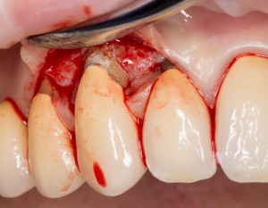 немедленная имплантация: удаление поврежденного клыка