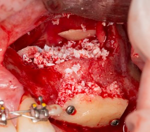 последствия ороантрального свища - существенная утрата костной ткани на верхней челюсти. Используется как аутокостный блок, так и аутокостная стружка в сочетании с биоматериалом и барьерной мембраной.