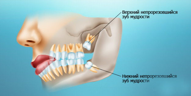 IMPLANT-IN.COM – дентальная имплантация. естественно. | Почему стоит  удалять зубы мудрости, даже если они не беспокоят? Кисты, биоматериалы и  хирургия