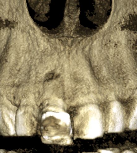 компьютерная томография позволяет увидеть кость такой, какая она есть
