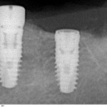 Операция закончена! В области 36 зуба стоит имплантат XiVE с формирователем десны, в области 37 зуба - без формирователя. Зуб мудрости удален, на снимке видна часть его лунки.