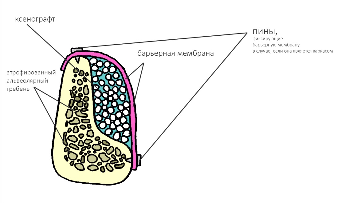 Использованная мембрана. Барьерная мембрана. Костная пластика с мембраной. Барьерная мембрана в стоматологии.