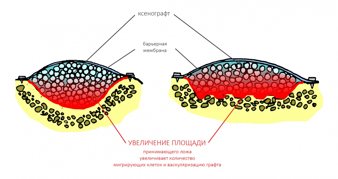 Барьерная территория. Костная мембрана в стоматологии. Барьерная мембрана в стоматологии. Резорбируемая мембрана в стоматологии. Нерезорбируемые мембраны в стоматологии.