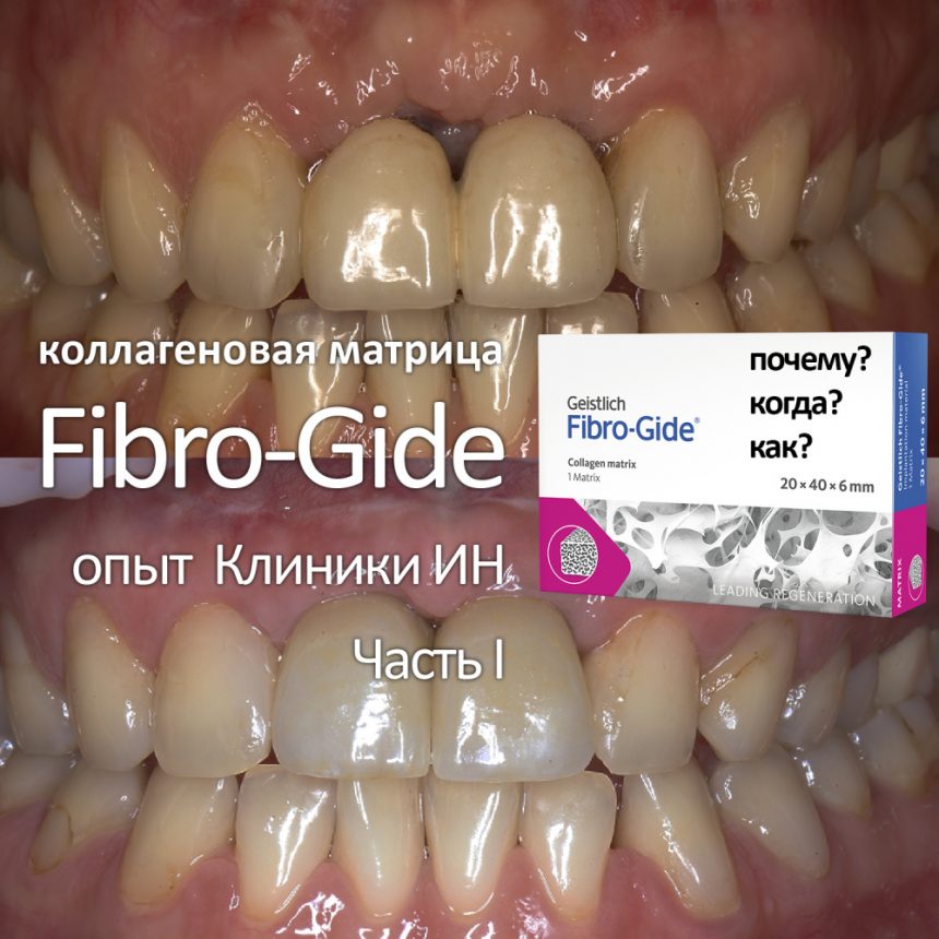 IMPLANT-IN.COM — дентальная имплантация. естественно. — хирургия ...