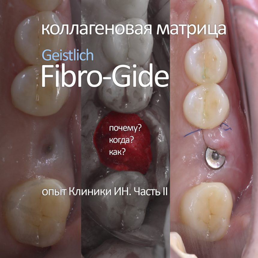 IMPLANT-IN.COM — дентальная имплантация. естественно. — хирургия ...
